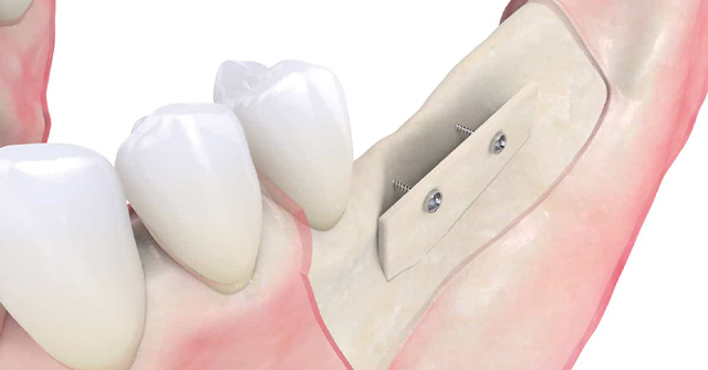 1534829333-ridge-augmentation1