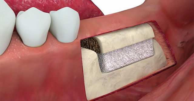 1534829333-ridge-augmentation3